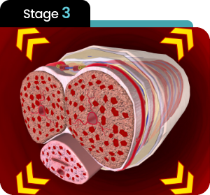 Stage 3 infographic demonstrating maximum expansion of the penile tissue due to elevated blood flow pressure.